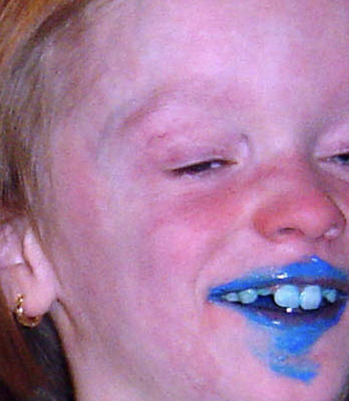 Facial Rash 3