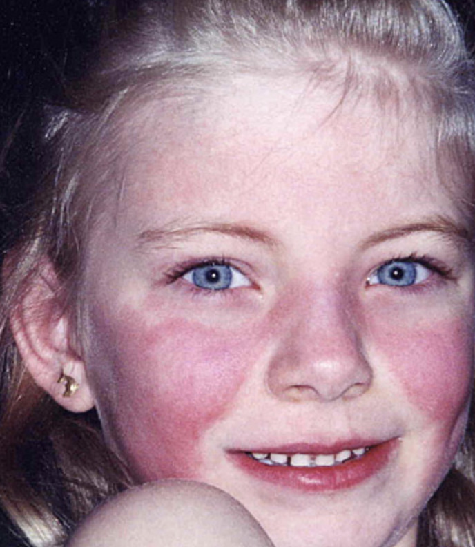 Facial Rash 5