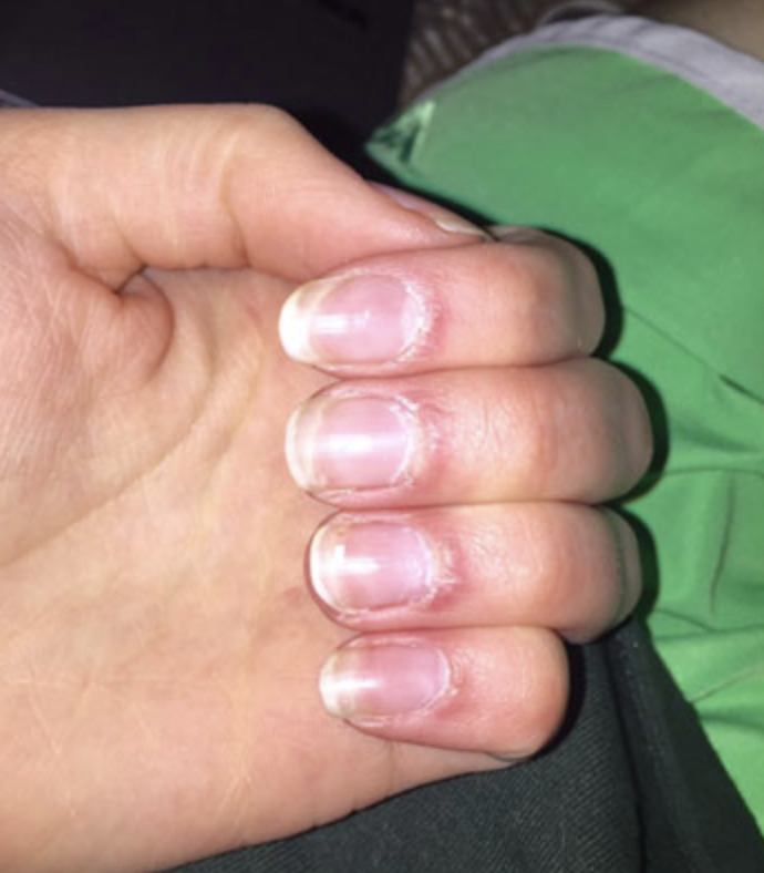 Fingernail and nail-fold abnormalities: Nail-fold telangiectasis and periungual erythema