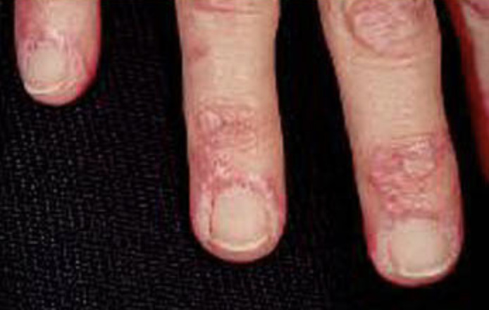 Gottron Papules 3