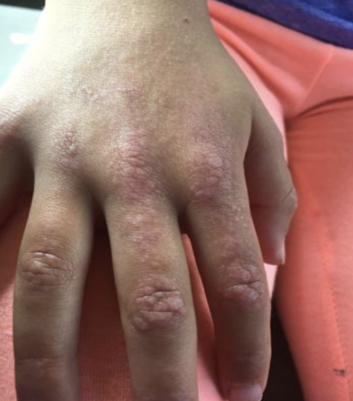 Gottron Papules 4