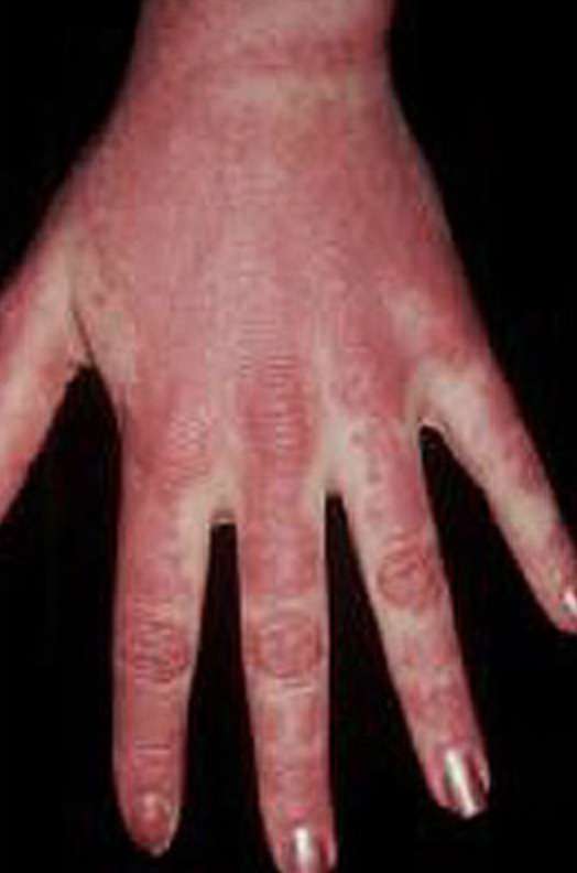 Hand Rash 2