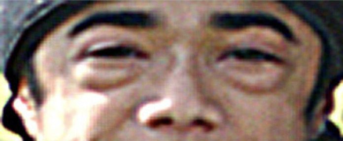 Lipodystrophy