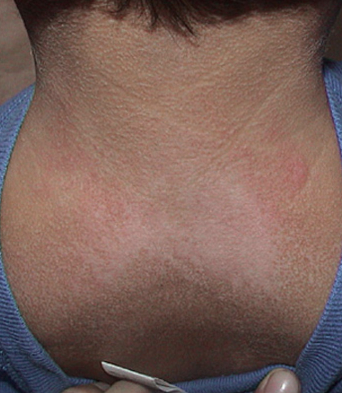 Neck Rash