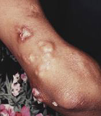 Calcinosis