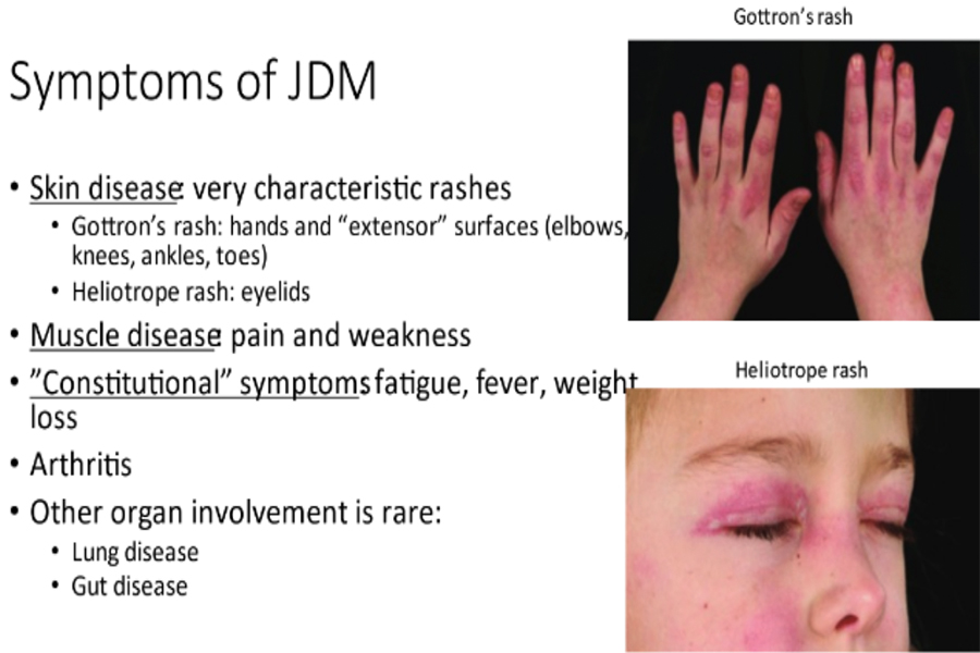 Clinicians Cure JM Foundation